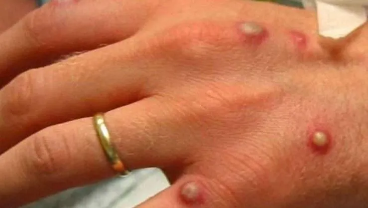 virus monkeypox virus monkeypox