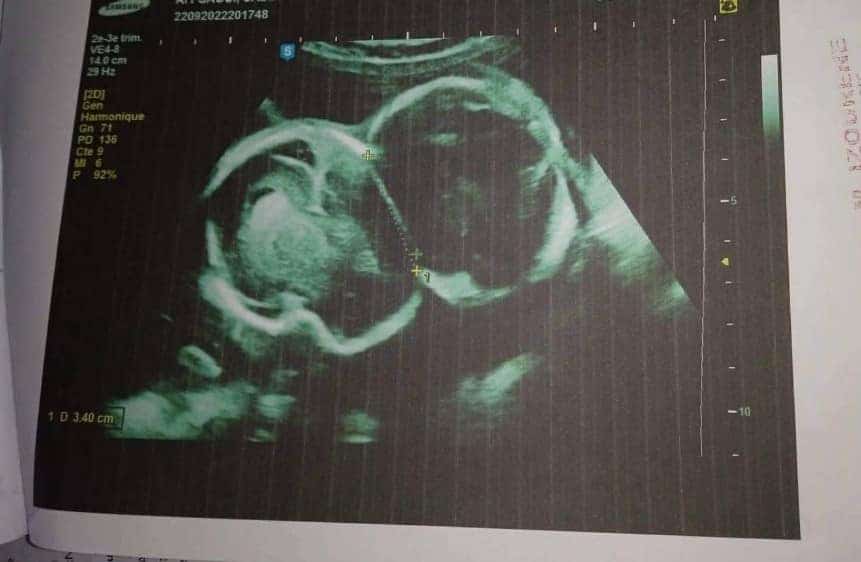 Tizi-Ouzou : une femme enceinte de jumeaux siamois sollicite l’aide des autorités