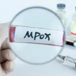 Mpox : Une nouvelle alerte sanitaire en France, faut-il s’inquiéter ?