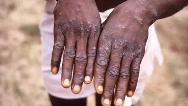 Le ministère de la Santé apporte des précisions sur le monkeypox en Algérie