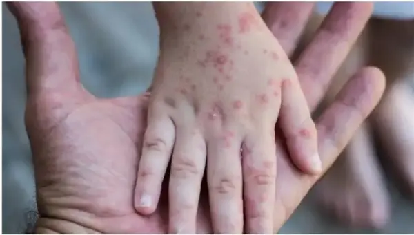 L&rsquo;Organisation mondiale de la santé a tenu une réunion d&rsquo;urgence .. La terreur balaie le monde en raison de la maladie du monkeypox