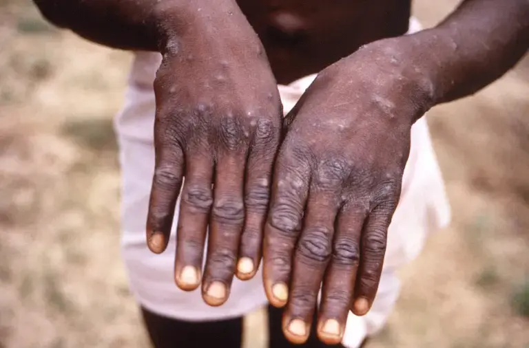 monkeypox