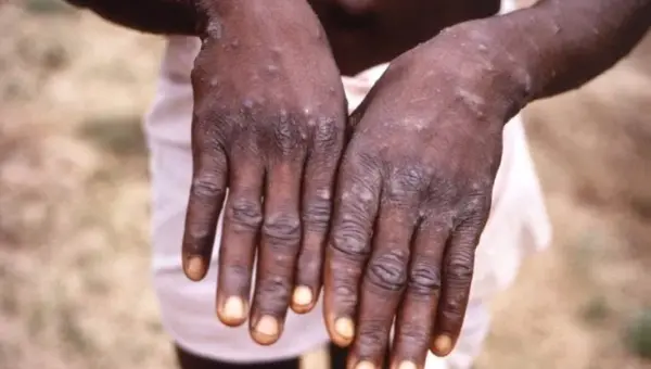 Premier décès lié à la variole du singe signalé en Europe
