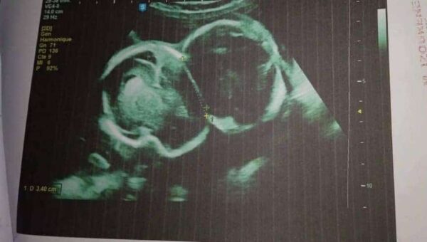 Tizi-Ouzou : une femme enceinte de jumeaux siamois sollicite l’aide des autorités